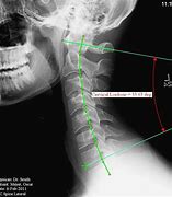 Straight Cervical Adalah